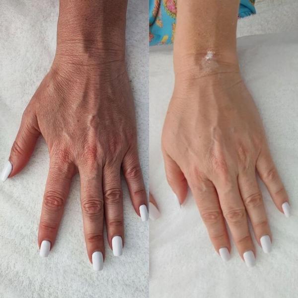 Как будут выглядеть руки после контурной пластики – средства против сухости и старения кожи