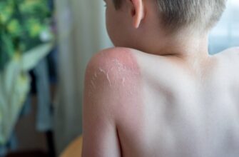 Солнечные ожоги у детей: чем помочь, причины и симптомы
