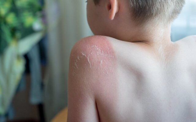 Солнечные ожоги у детей: чем помочь, причины и симптомы